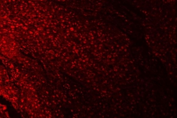 Immunofluorescent staining of FFPE human esophageal squamous cell carcinoma tissue with RPRD1B antibody (red). HIER: steam section in pH8 EDTA buffer for 20 min.