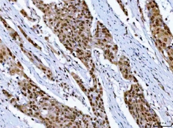 IHC staining of FFPE human esophageal squamous carcinoma tissue with RPRD1B antibody. HIER: boil tissue sections in pH8 EDTA for 20 min and allow to cool before testing.