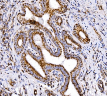 IHC staining of FFPE human gallbladder adenocarcinoma tissue with COX6B1 antibody. HIER: boil tissue sections in pH8 EDTA for 20 min and allow to cool before testing.