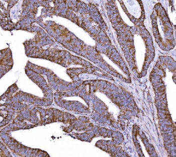 IHC staining of FFPE human colorectal cancer tissue with COX6B1 antibody. HIER: boil tissue sections in pH8 EDTA for 20 min and allow to cool before testing.