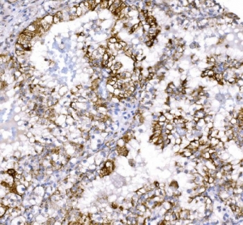 IHC staining of FFPE human renal clear cell carcinoma tissue with COX6B1 antibody. HIER: boil tissue sections in pH8 EDTA for 20 min and allow to cool before testing.