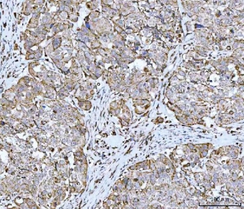 IHC staining of FFPE human urothelial carcinoma with squamous differentiation with GRIM19 antibody. HIER: boil tissue sections in pH8 EDTA for 20 min and allow to cool before testing.