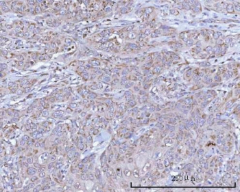 IHC staining of FFPE human skin squamous carcinoma tissue with NDUFB7 antibody. HIER: boil tissue sections in pH8 EDTA for 20 min and allow to cool before testing.