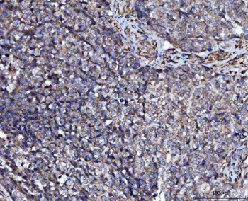 IHC staining of FFPE human ovarian cancer tissue with PRMT7 antibody. HIER: boil tissue sections in pH8 EDTA for 20 min and allow to cool before testing.