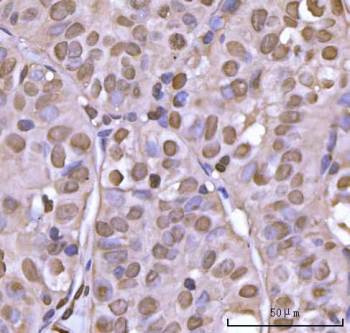 IHC staining of FFPE human thyroid papillary carcinoma tissue with NEIL3 antibody. HIER: boil tissue sections in pH8 EDTA for 20 min and allow to cool before testing.