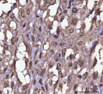 IHC staining of FFPE human urothelial carcinoma tissue with NEIL3 antibody. HIER: boil tissue sections in pH8 EDTA for 20 min and allow to cool before testing.