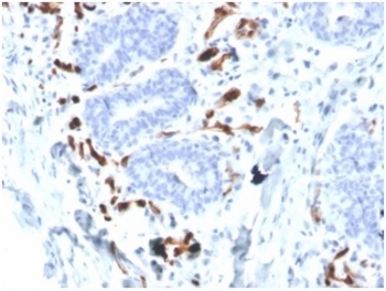 IHC staining of FFPE human breast carcinoma tissue with FABP4 antibody (clone FABP4/4426) at 2ug/ml in PBS for 30min RT. HIER: boil tissue sections in pH 9 10mM Tris with 1mM EDTA for 20 min and allow to cool before testing.