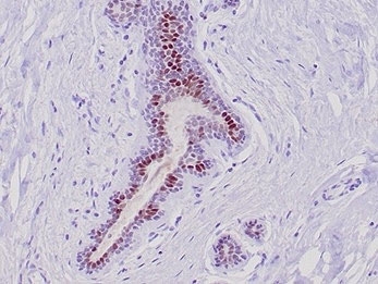 IHC staining of FFPE human lobular breast carcinoma tissue with GATA Binding Protein 3 antibody (clone GATA3/6664). HIER: boil tissue sections in pH 9 10mM Tris with 1mM EDTA for 20 min and allow to cool before testing.