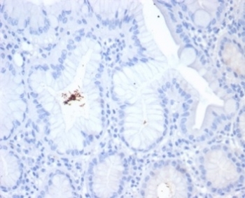 IHC staining of H. pylori-infected FFPE human stomach tissue with Helicobacter pylori antibody (clone HPYL/7229). HIER: boil tissue sections in pH 9 10mM Tris with 1mM EDTA for 20 min and allow to cool before testing.