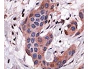 IHC analysis of FFPE human breast carcinoma tissue stained with the Bid antibody
