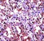 HSF1 antibody immunohistochemistry analysis in formalin fixed and paraffin embedded human kidney carcinoma.
