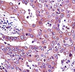 JAK2 antibody immunohistochemistry analysis in formalin fixed and paraffin embedded human lung adenocarcinoma.~