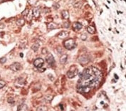 IHC analysis of FFPE human hepatocarcinoma tissue stained with the Recoverin antibody~