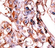 IHC analysis of FFPE human hepatocarcinoma tissue stained with the phospho-HER4 antibody.
