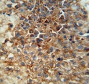 CD46 antibody immunohistochemistry analysis in formalin fixed and paraffin embedded human hepatocarcinoma. HIER: steam section in pH6 citrate buffer for 20 min and allow to cool prior to staining.