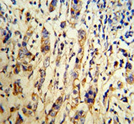 A1BG antibody IHC analysis in formalin fixed and paraffin embedded human breast carcinoma tissue.