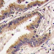 IHC analysis of FFPE human lung carcinoma tissue stained with ERK4 antibody