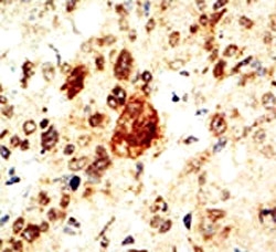 IHC analysis of FFPE human breast carcinoma tissue stained with the EphA1 antibody