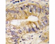 IHC analysis of FFPE human prostate carcinoma tissue stained with PDGFRA antibody