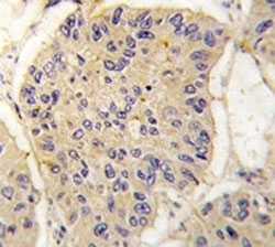 IHC analysis of FFPE human lung carcinoma tissue stained with FKBP12 antibody~