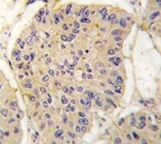 IHC analysis of FFPE human lung carcinoma tissue stained with FKBP12 antibody