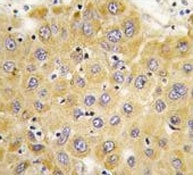 IHC analysis of FFPE human hepatocarcinoma tissue stained with Connective Tissue Growth Factor antibody