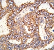 IHC analysis of FFPE human prostate carcinoma tissue stained with TRPM8 antibody