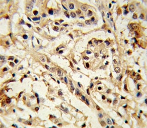 IHC analysis of FFPE human breast carcinoma stained with BMI1 antibody