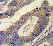 IHC testing of FFPE human colon carcinoma with Epiregulin antibody. HIER: steam section in pH6 citrate buffer for 20 min and allow to cool prior to staining.