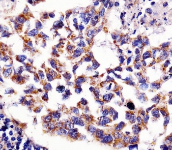 IHC testing of FFPE human lung adenocarcinoma tissue with 60 kDa Heat Shock Protein antibody. HIER: steam section in pH6 citrate buffer for 20 min and allow to cool prior to staining.