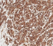 IHC testing of FFPE human breast carcinoma tissue with Cathepsin D antibody. HIER: steam section in pH9 EDTA for 20 min and allow to cool prior to staining.
