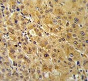 IHC testing of FFPE human hepatocellular carcinoma tissue with FKBP1A antibody. HIER: steam section in pH6 citrate buffer for 20 min and allow to cool prior to staining.