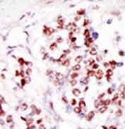 IHC testing of FFPE human cancer tissue with Tousled-like kinase 1 antibody. HIER: steam section in pH6 citrate buffer for 20 min and allow to cool prior to staining.