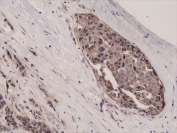 IHC testing of FFPE human breast cancer tissue with recombinant Beta Catenin antibody at 1:1000.