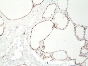 IHC staining of FFPE human thyroid tissue with recombinant PAX8 antibody at 1:400.