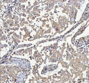 IHC staining of FFPE human lung cancer tissue with SSH3BP1 antibody. HIER: boil tissue sections in pH8 EDTA for 20 min and allow to cool before testing.