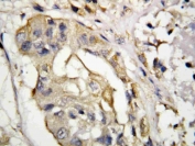 IHC staining of FFPE human breast cancer with CD40L antibody. HIER: boil tissue sections in pH6, 10mM citrate buffer, for 10-20 min followed by cooling at RT for 20 min.
