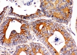 IHC-P: Integrin alpha 1 antibody testing of human intestinal cancer tissue. HIER: steamed with pH6 citrate buffer.