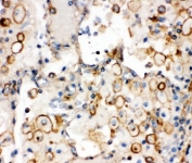 IHC-P: Integrin alpha 1 antibody testing of human lung cancer tissue. HIER: steamed with pH6 citrate buffer.