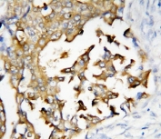 IHC-P: Presenilin 2 antibody testing of human breast cancer tissue. HIER: steamed with pH6 citrate buffer.