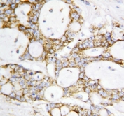 IHC-P: Lipoamide Dehydrogenase antibody testing of human breast cancer tissue