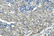IHC staining of FFPE human breast cancer with Desmoglein 2 antibody. HIER: boil tissue sections in pH8 EDTA buffer, for 20 min and allow to cool before testing.