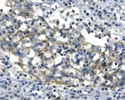IHC staining of FFPE human lung cancer with Desmoglein 2 antibody. HIER: boil tissue sections in pH8 EDTA buffer, for 20 min and allow to cool before testing.