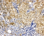 IHC-P: Vinculin antibody testing of human breast cancer tissue. Required HIER: steam section in pH6 citrate buffer for 20 min.