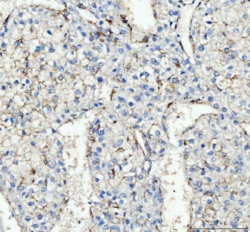 IHC staining of FFPE human liver cancer tissue with CD163 antibody. HIER: boil tissue sections in pH8 EDTA for 20 min and allow to cool before testing.