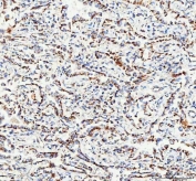 IHC staining of FFPE human lung adenocarcinoma tissue with TFAM antibody. HIER: boil tissue sections in pH8 EDTA for 20 min and allow to cool before testing.