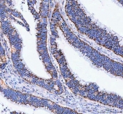 IHC staining of FFPE human colorectal adenocarcinoma tissue with TFAM antibody. HIER: boil tissue sections in pH8 EDTA for 20 min and allow to cool before testing.