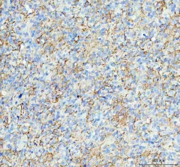IHC staining of FFPE human glioma tissue with Aquaporin 4 antibody. HIER: boil tissue sections in pH8 EDTA for 20 min and allow to cool before testing.