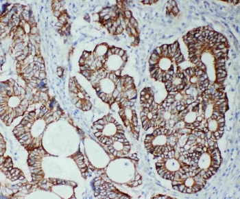 IHC staining of FFPE human intestinal cancer tissue with ZO-2 antibody. HIER: boil tissue sections in pH8 EDTA for 20 min and allow to cool before testing.