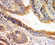 IHC-P: SLC1A4 antibody testing of human intestine cancer tissue